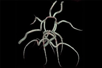 Willis环（Circle of Willis）大脑动脉环、威廉斯环 